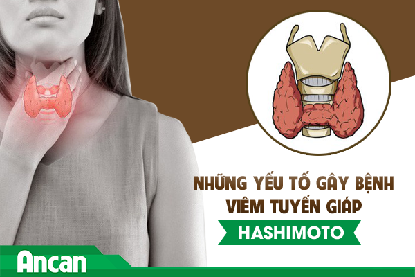Những yếu tố gây bệnh viêm tuyến giáp Hashimoto