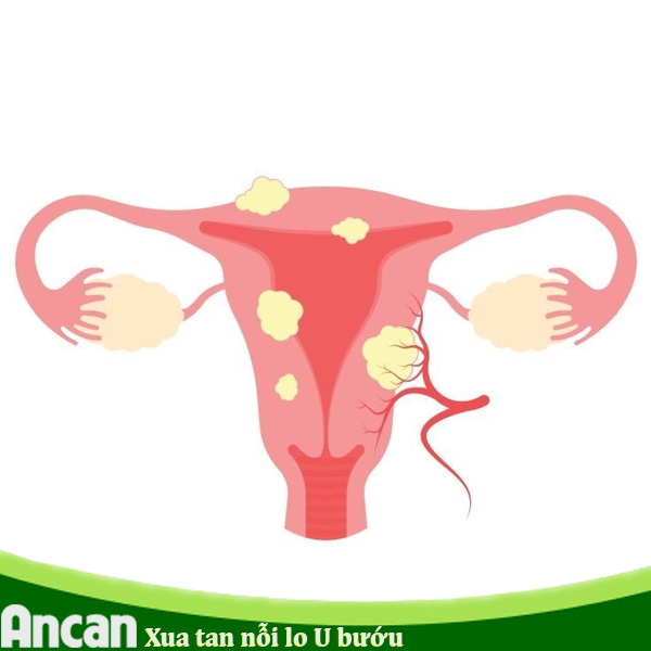 Có nên điều trị u xơ tử cung với Ancan
